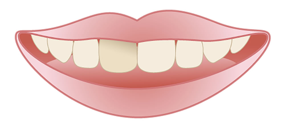 神経を抜いた歯が変色する原因と改善方法
