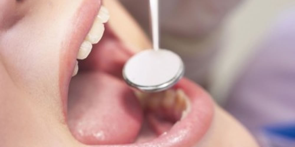 歯のクリーニングの種類と注意点