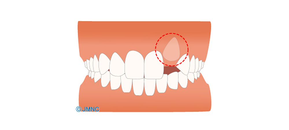 歯が歯茎の中にある埋伏歯の原因や治療法とは？