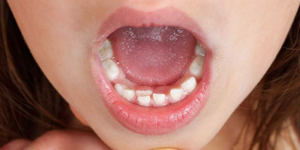 転位歯の原因と治療法