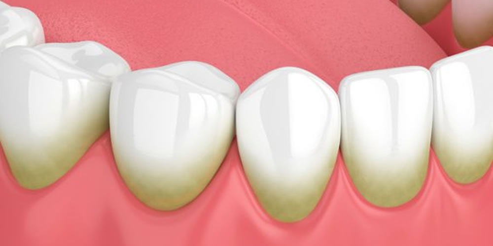 歯の表面がザラザラしている原因と解決法とは？