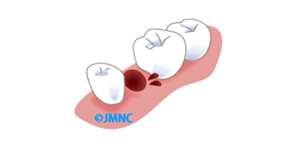 歯を抜いた後の出血が止まらない原因と応急処置とは？