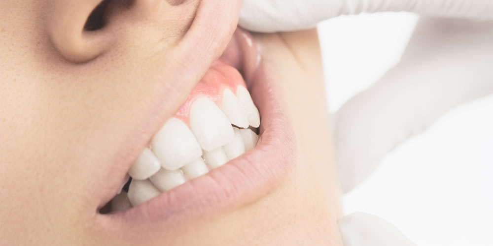 歯茎にできるできもの（フィステル）の原因と対処法とは？