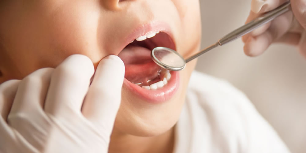 乳歯（子供の歯）の虫歯を治療しないことで生じる問題とは？