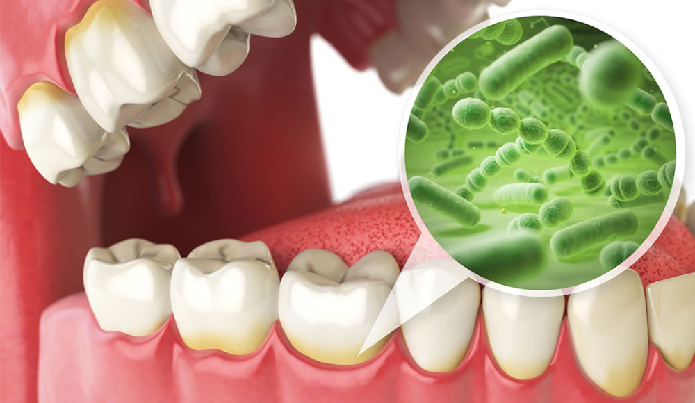 歯周病が進行・悪化する8つの原因とは？