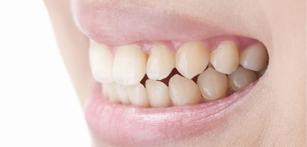 奥歯の咬み合わせが悪い原因と生じるトラブル