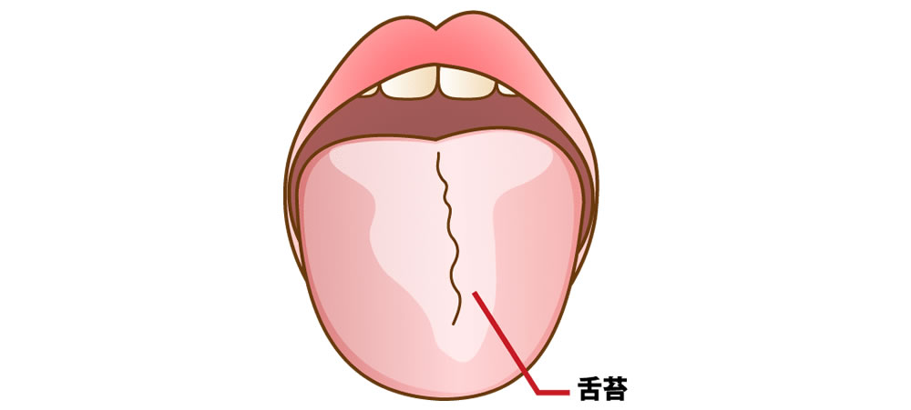 舌に付着した汚れ「舌苔」の原因と影響とは？