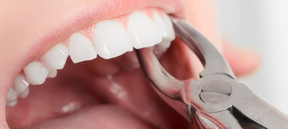 矯正治療で歯を抜く理由・抜歯矯正のメリットとは？