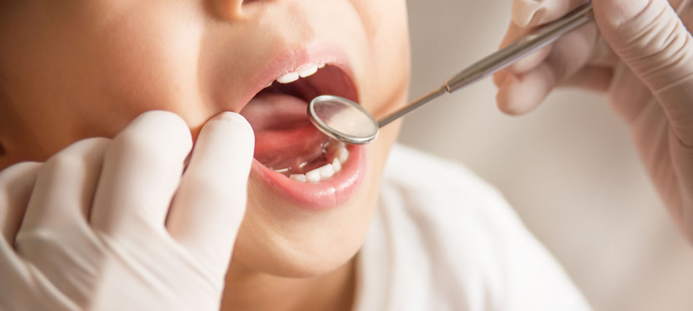 子どもが虫歯になりやすい場所と成長に適した口腔ケアのポイント