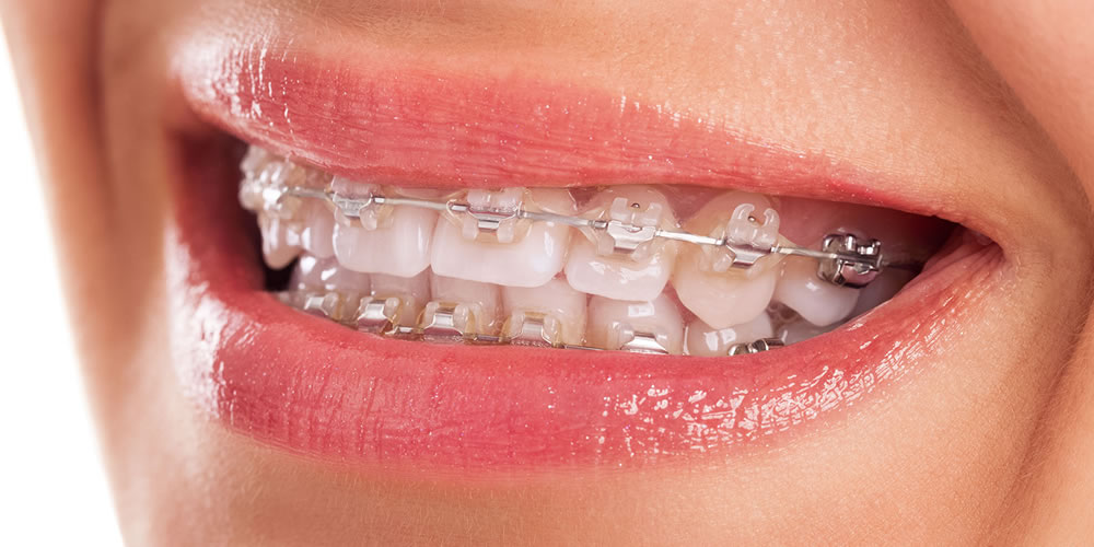 矯正治療で歯が動きやすい人の特徴について