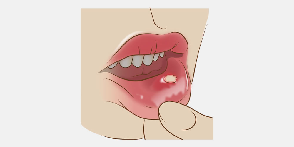 お口の中・唇にできる口内炎を予防する習慣とは？