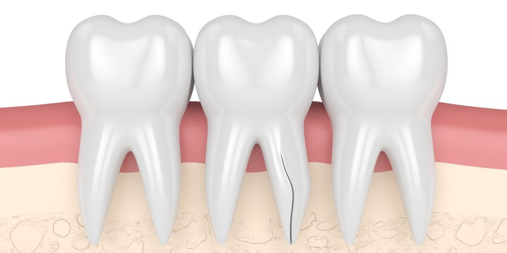 歯のひび・歯が割れる歯根破折の症状や原因とは？