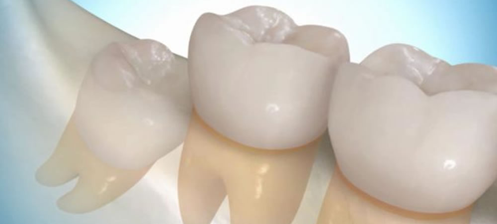 親知らず抜歯後に注意すべきドライソケットの症状と対策とは？
