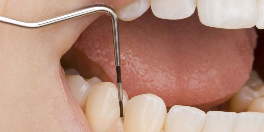 歯周病から天然歯を守る！歯周病検査の内容とは？