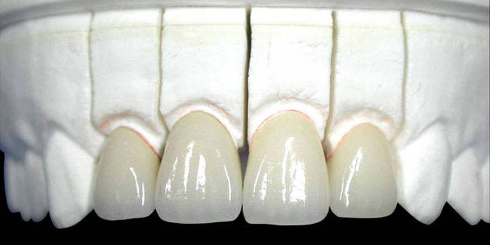 歯科治療で使用されるセラミック素材