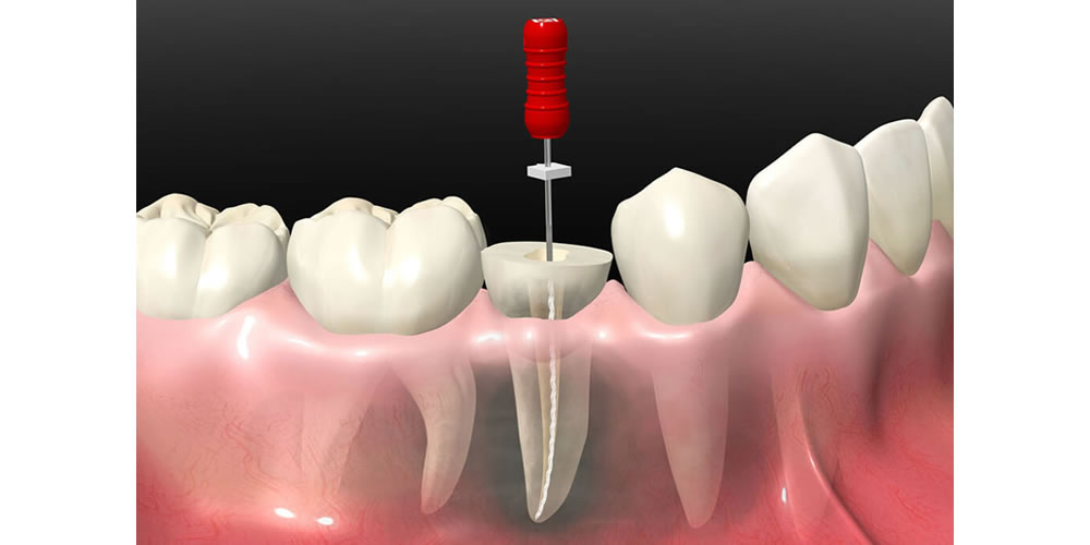 歯の神経を抜いたらどうなる？神経除去後に起こる変化とは？