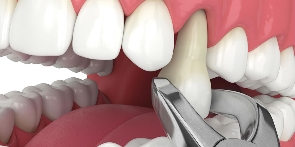 矯正治療で抜歯が必要となるケースとは？