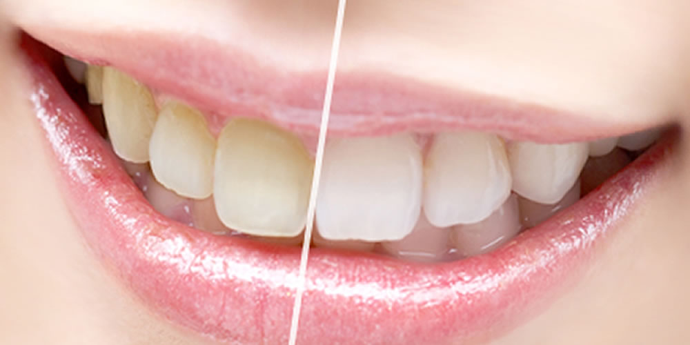 歯が変色（黄ばみ・黒ずみ）する原因