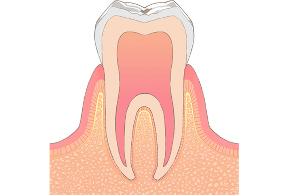 初期虫歯・エナメル質の虫歯