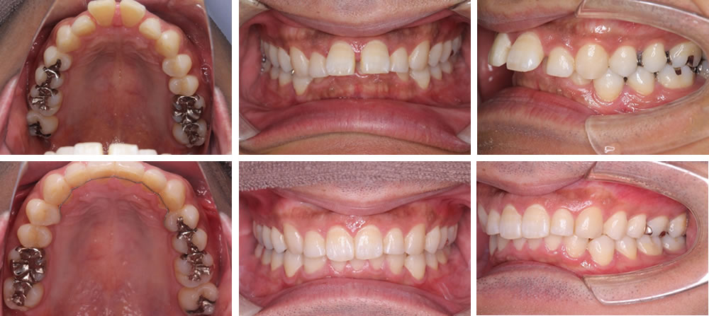 すきっ歯の矯正治療のビフォーアフター