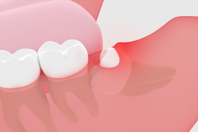 親知らずの虫歯を放置するデメリットについて解説‼早く治療することが大切